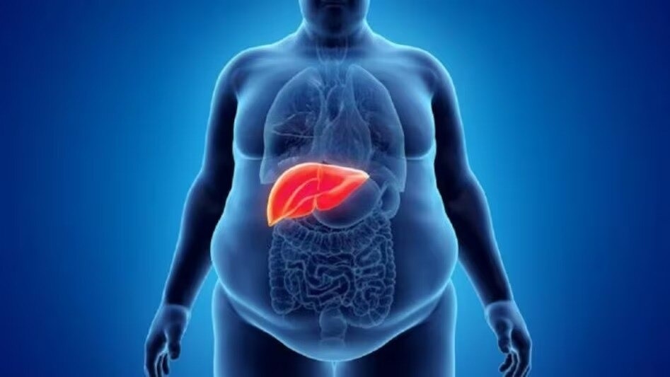 6887894065c03-fatty-liver-240408991-16x9.jpeg